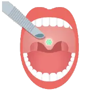 パルスサーミアで治療している喉のイラスト