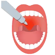 ナイトレーズで治療している喉のイラスト