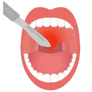 切除法で治療している喉のイラスト