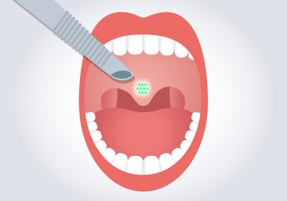 レーザーによる照射されている喉のイラスト