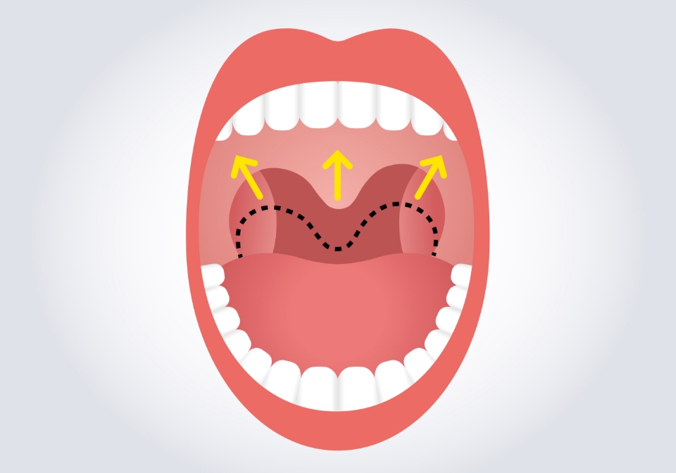 温熱療法により引き締まった喉のイラスト
